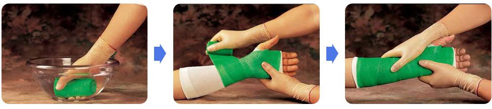 استخدام رباط ضاغط OptimaCast™ GreenCast™
للمفاصل وسيلة مساعدة لتسكين الألم الناتج عن الإصابات المختلفة
استخدام رباط ضاغط OptimaCast™ GreenCast™
لتقوية المفاصل من السهل الآن ا...